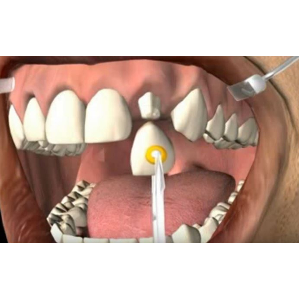 GDC Temporary Crown Removing Plier CR4562