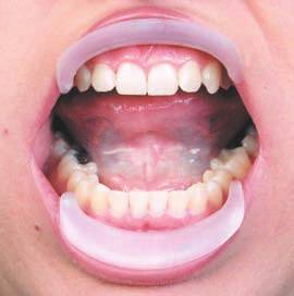 Cotisen Cheek Retractor