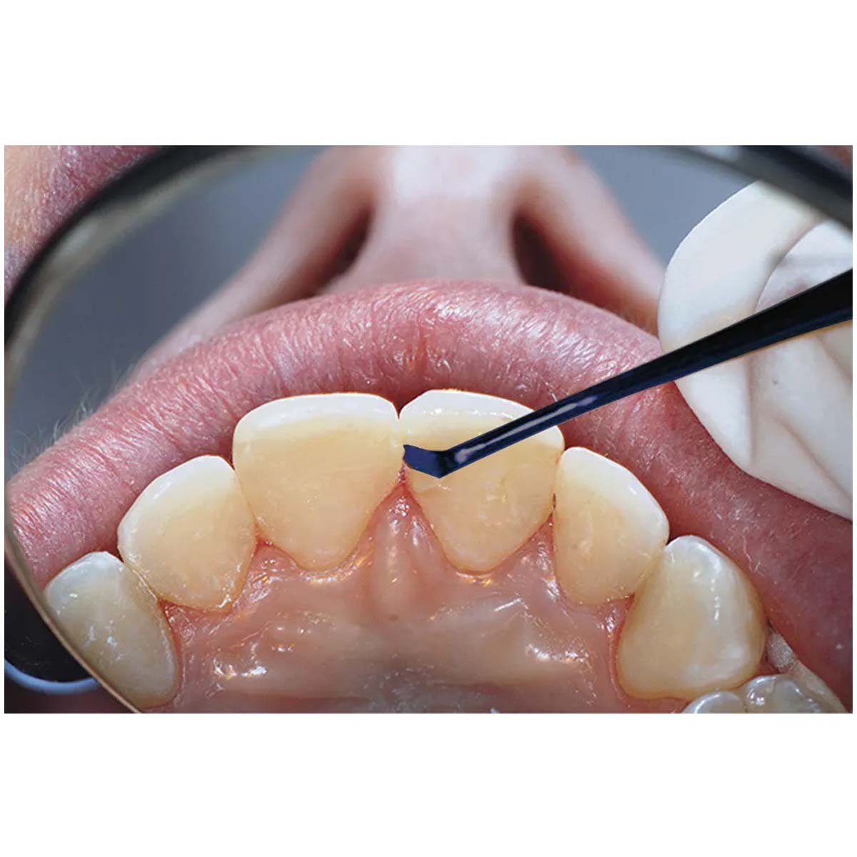 Oracraft Titanium Coated Composite Instruments