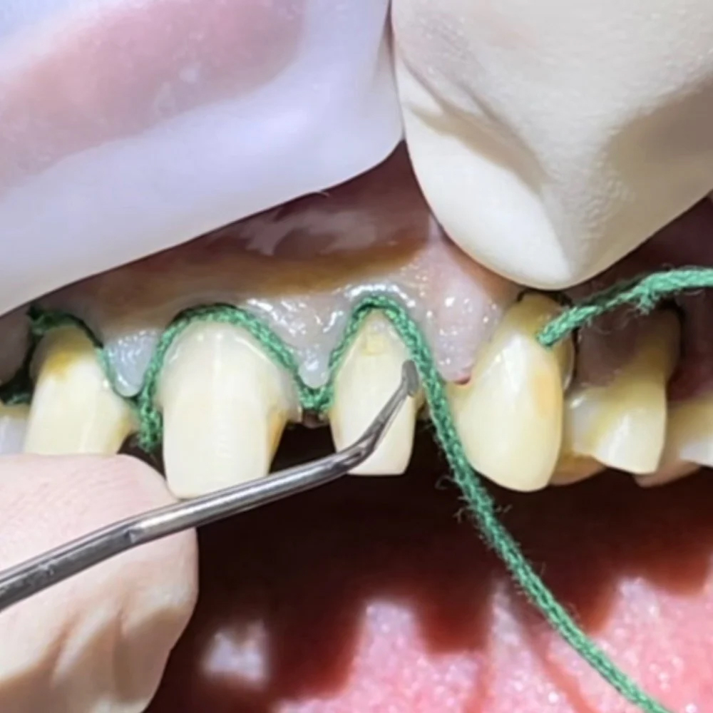 GDC Gingival Cord Packer Serrated #4 (Hollow Ring Handle) - GCPAS113