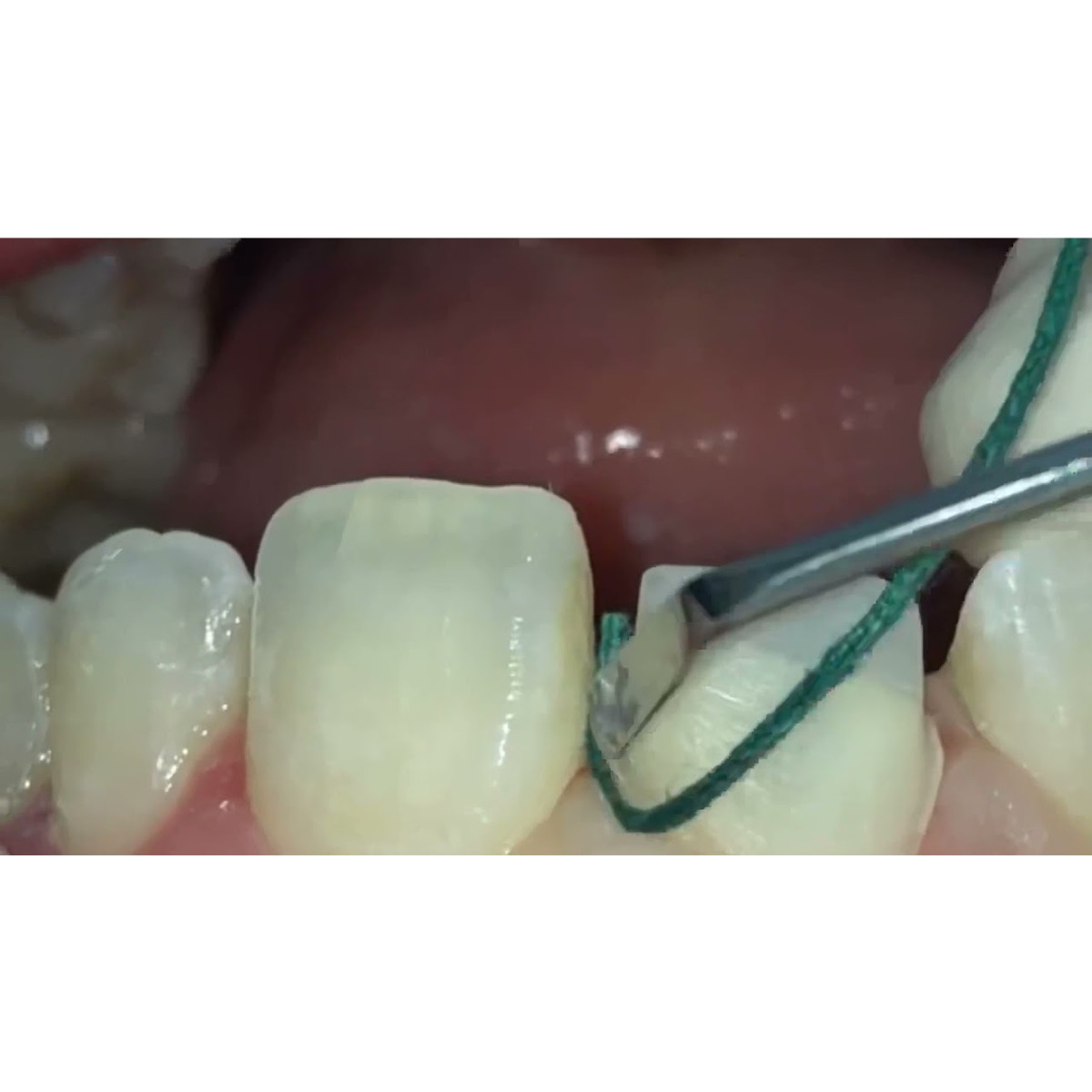 GDC Gingival Cord Packer Non-Serrated #4 (Gcpr7n)