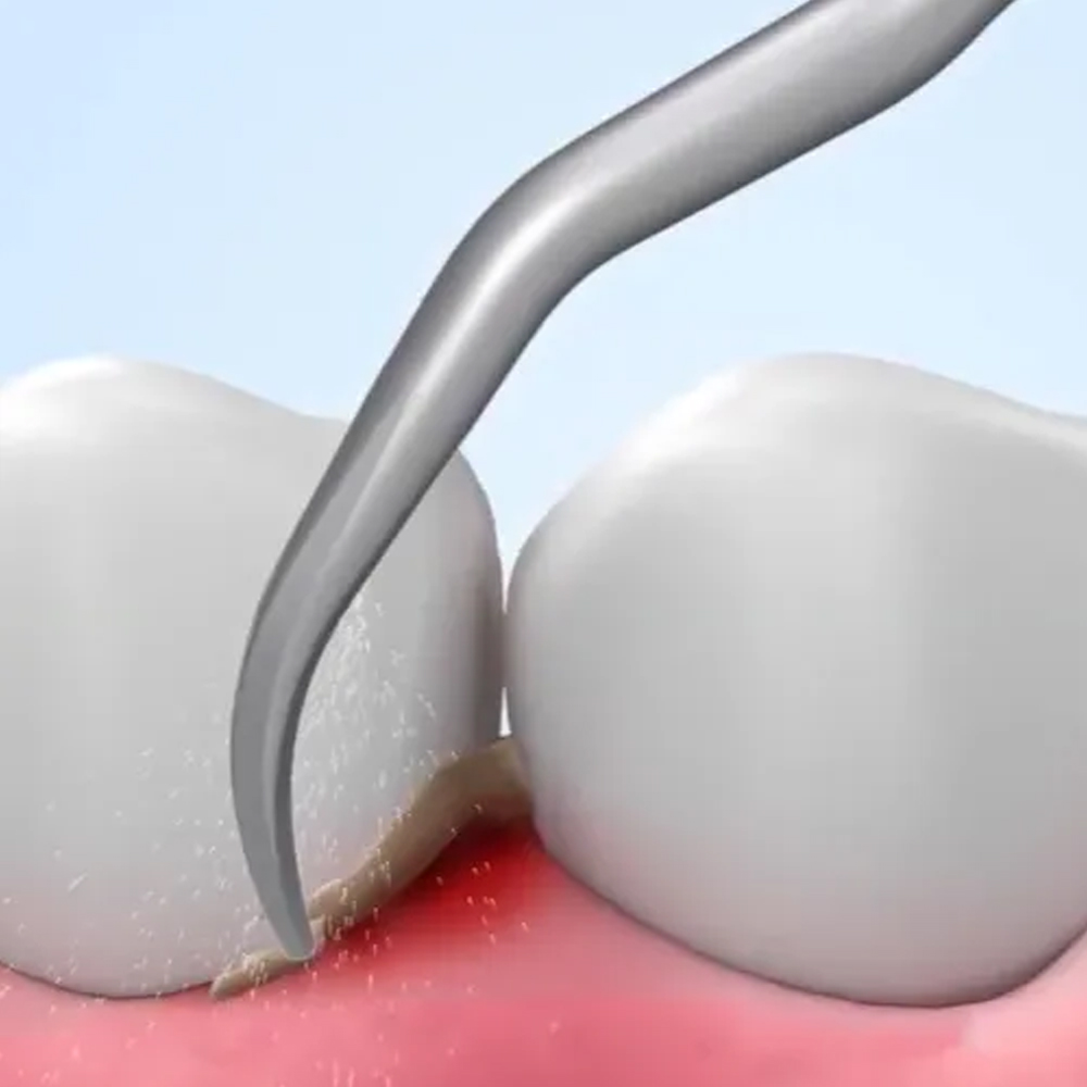 Woodpecker Scaler Tip GD10 for DTE & Satelec Scalers