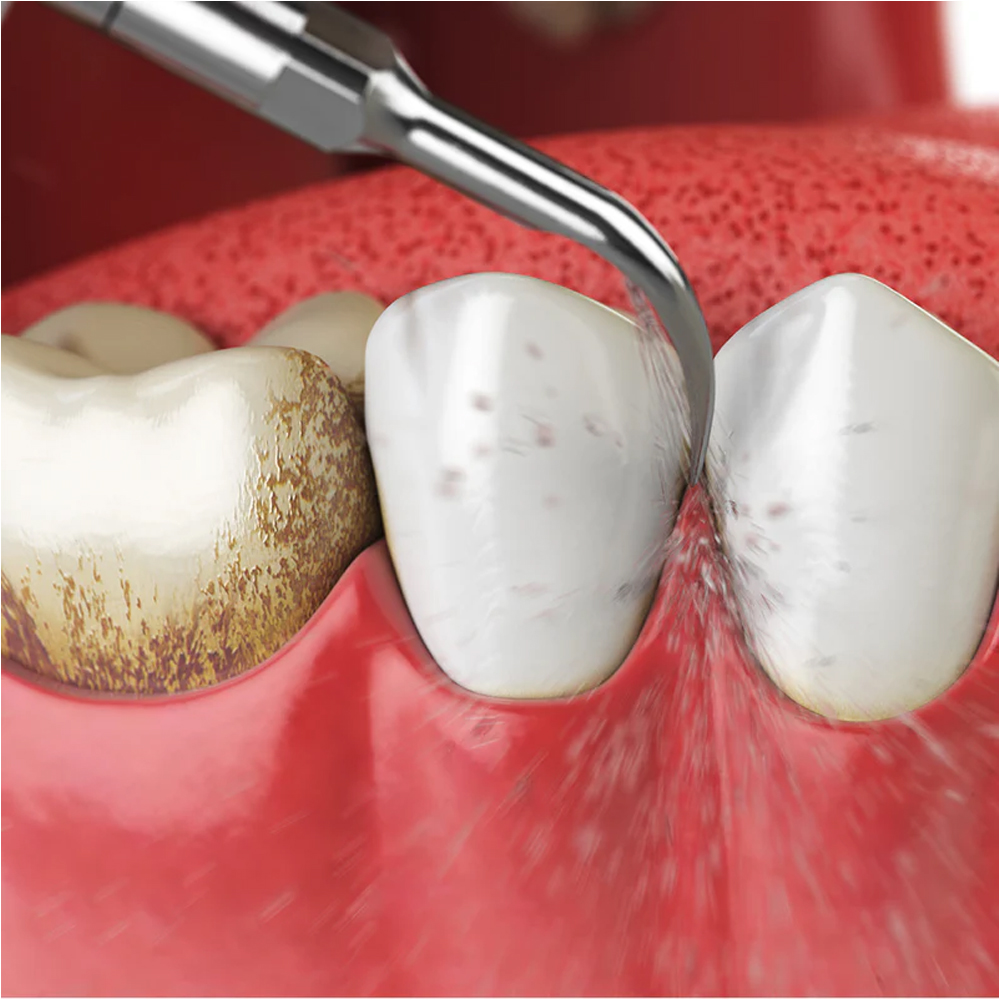 Woodpecker Scaler Tip GD4 for DTE & Satelec Scalers