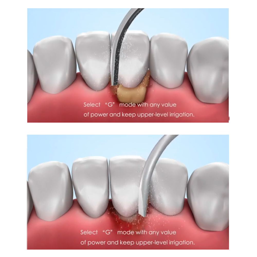 Woodpecker Scaler Tip G6 for UDS & EMS Scalers