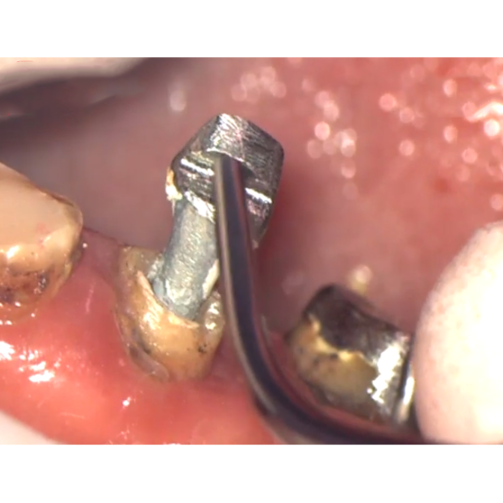 Woodpecker Scaler Tip GD8 for DTE & Satelec Scalers