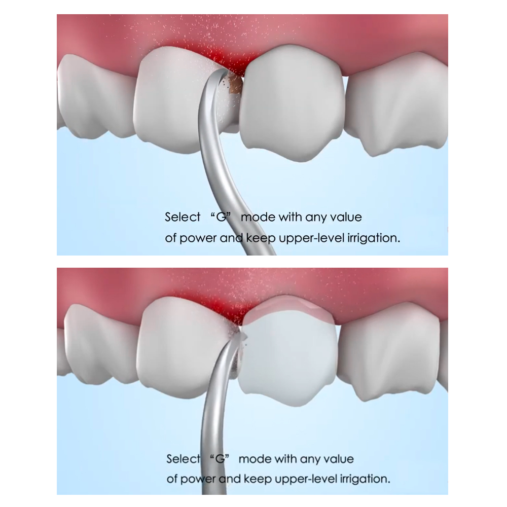 Woodpecker Scaler Tip GD9 for DTE & Satelec Scalers