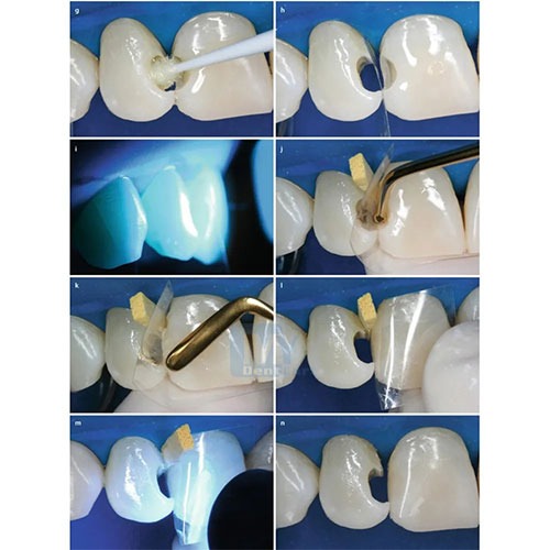 GDC Composite Instrument Gold Titanium -6 (CIG6)