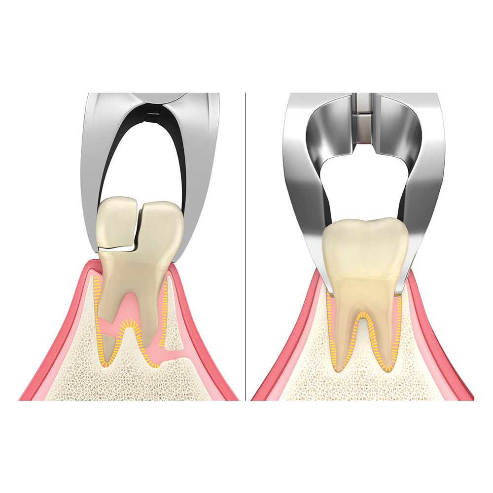 GDC Extraction Forceps Atraumatic