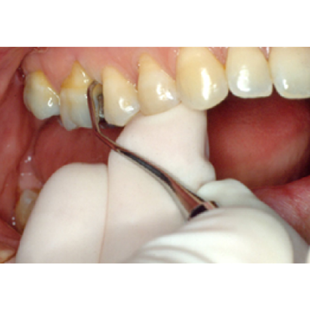 GDC Gracey Curettes #6 (Sg3/4)