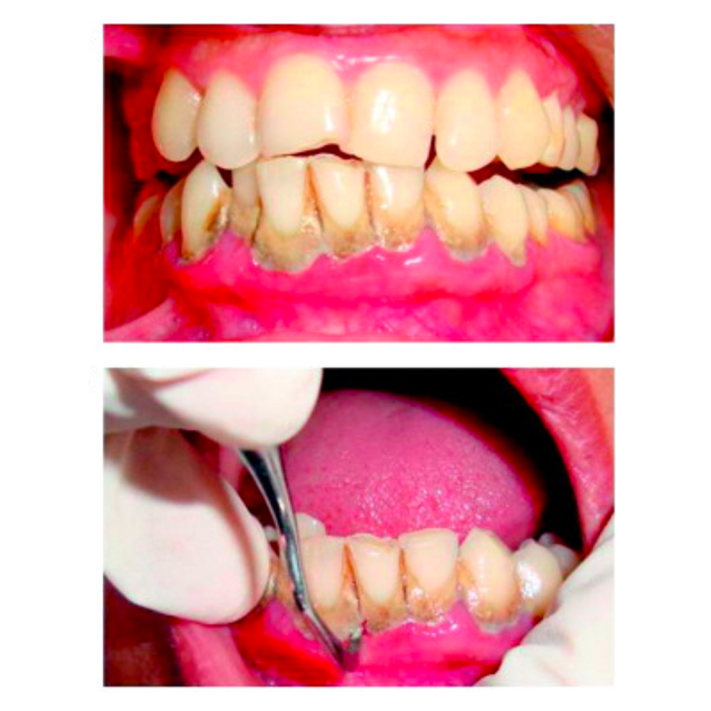 GDC Gracey Curettes #1 (Sg9/10)