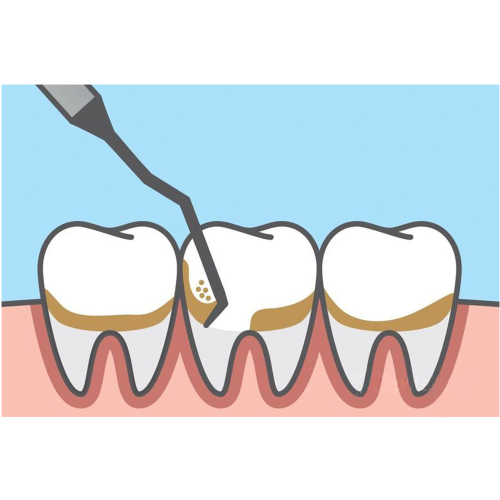 GDC Gracey Curettes #6 (Sg9/10)