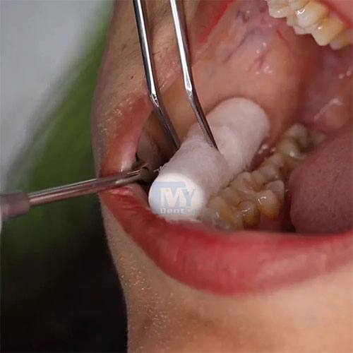 GI Dental Probe + Mouth Mirror + Tweezer (Pk of 10)