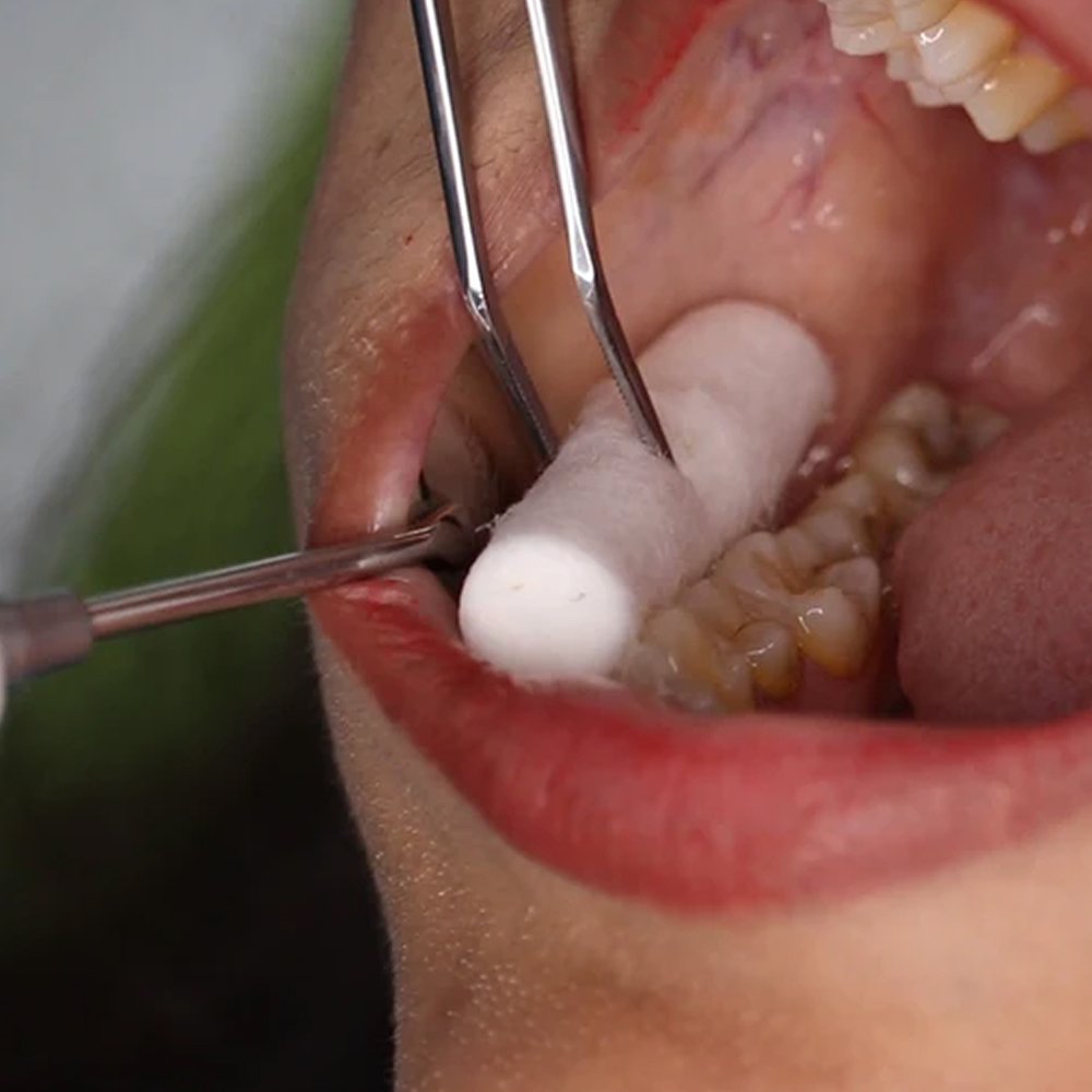 GDC Pmt Set Of 3 Instruments Kit Single Ended #3 (PMTS4)