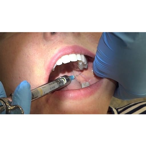 GDC Dental Syringe Aspirating With Ring (2.2ml) (SYRA2.2)