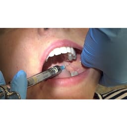 GDC Dental Syringe With Colour Coded Ring (Syracc1.8r) - 3