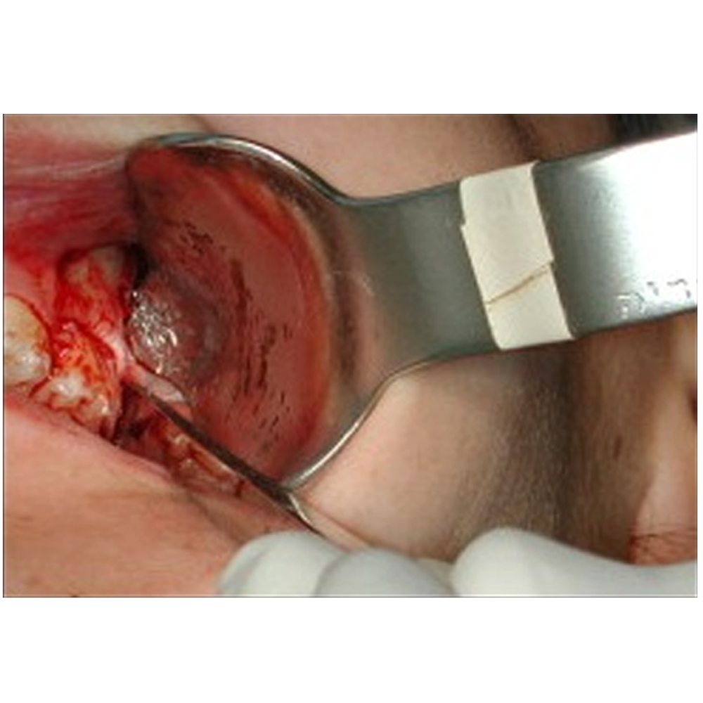 Julldent Laster 3rd Molar Retractor