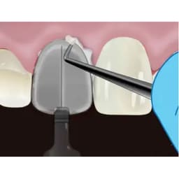 Waldent MyVeneer Composite Template System - 8
