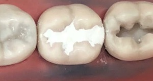 D-Tech Iono-Set Universal GIC Liquid