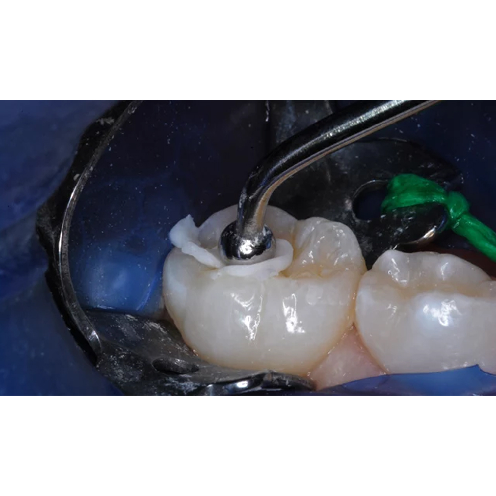 Medicept Dental Xtracem P (Posterior Restorative Cement)