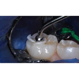 Medicept Dental Xtracem P (Posterior Restorative Cement) - 6