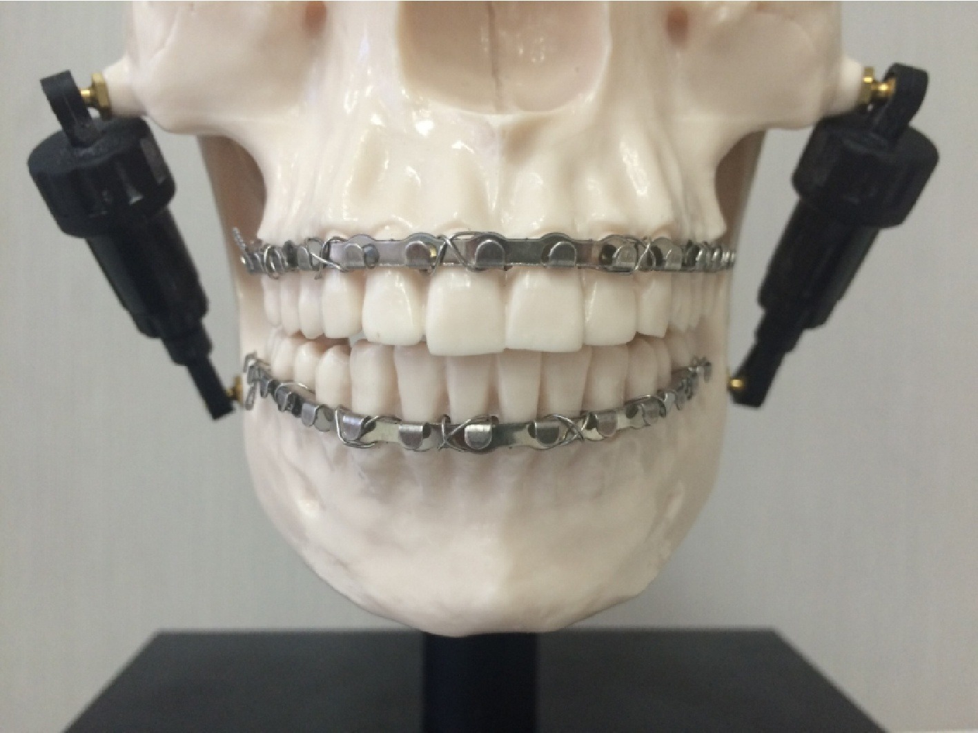 SK Surgicals Arch Bar  (504.001)