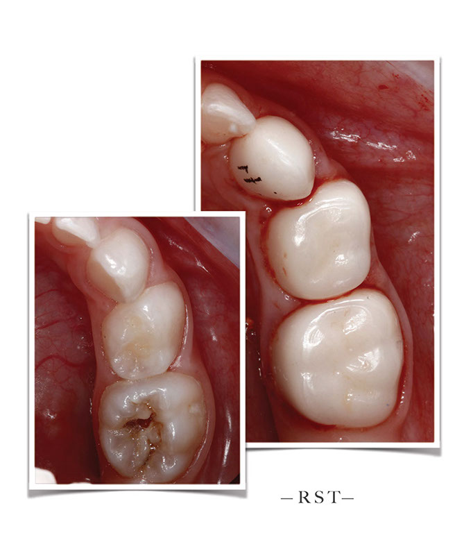 Kids-e-Dental BioFlx Upper Left 2nd Molar Crowns Refills
