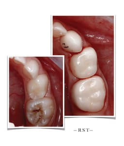 Kids-e-Dental BioFlx Upper Left 2nd Molar Crowns Refills - 6