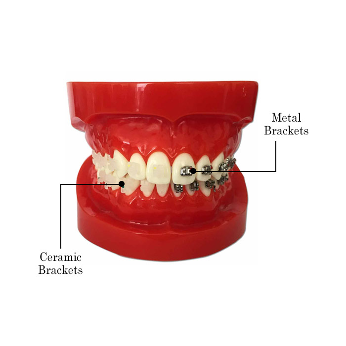 iDENTical Half Metal and Half Ceramic Brackets Orthodontic Models M3003