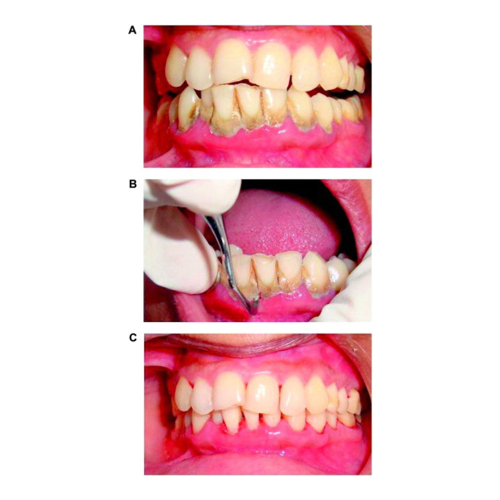 GDC Supra Gingival Scalers S/8 Instruments Kit (SGSP8)