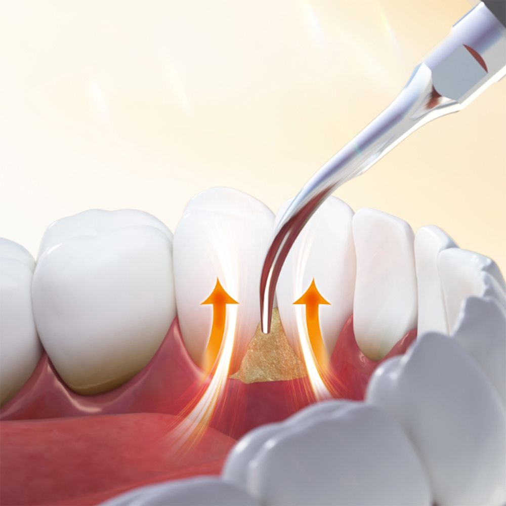 Woodpecker Scaler Tip GD1 for DTE & Satelec Scalers