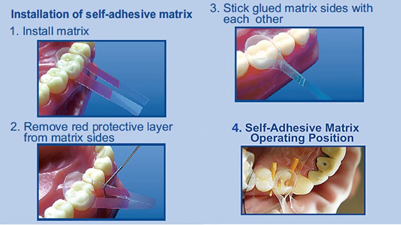 Tor Vm Transparent Contoured Matrices for Premolars & Molars