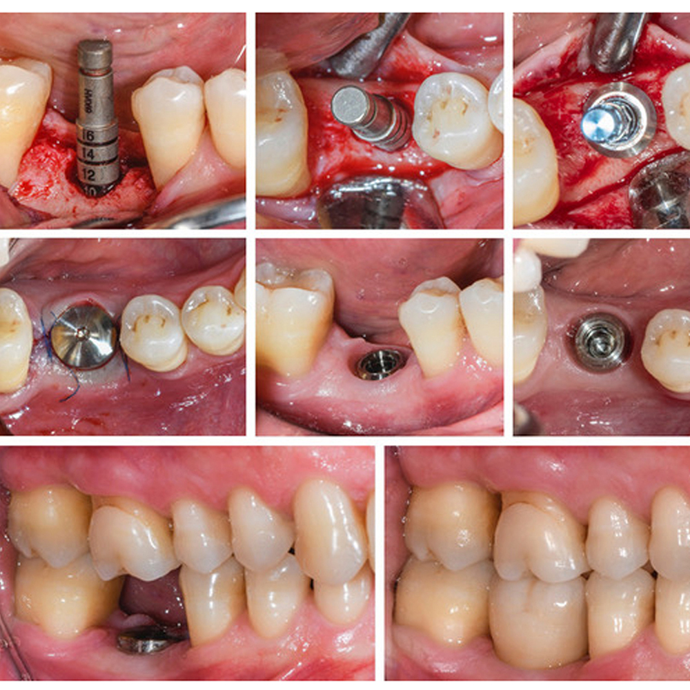 Xcem Dental Implant Submerged Healing Abutment 4.5mm