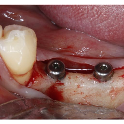Xcem Dental Implant Submerged Healing Abutment 4mm