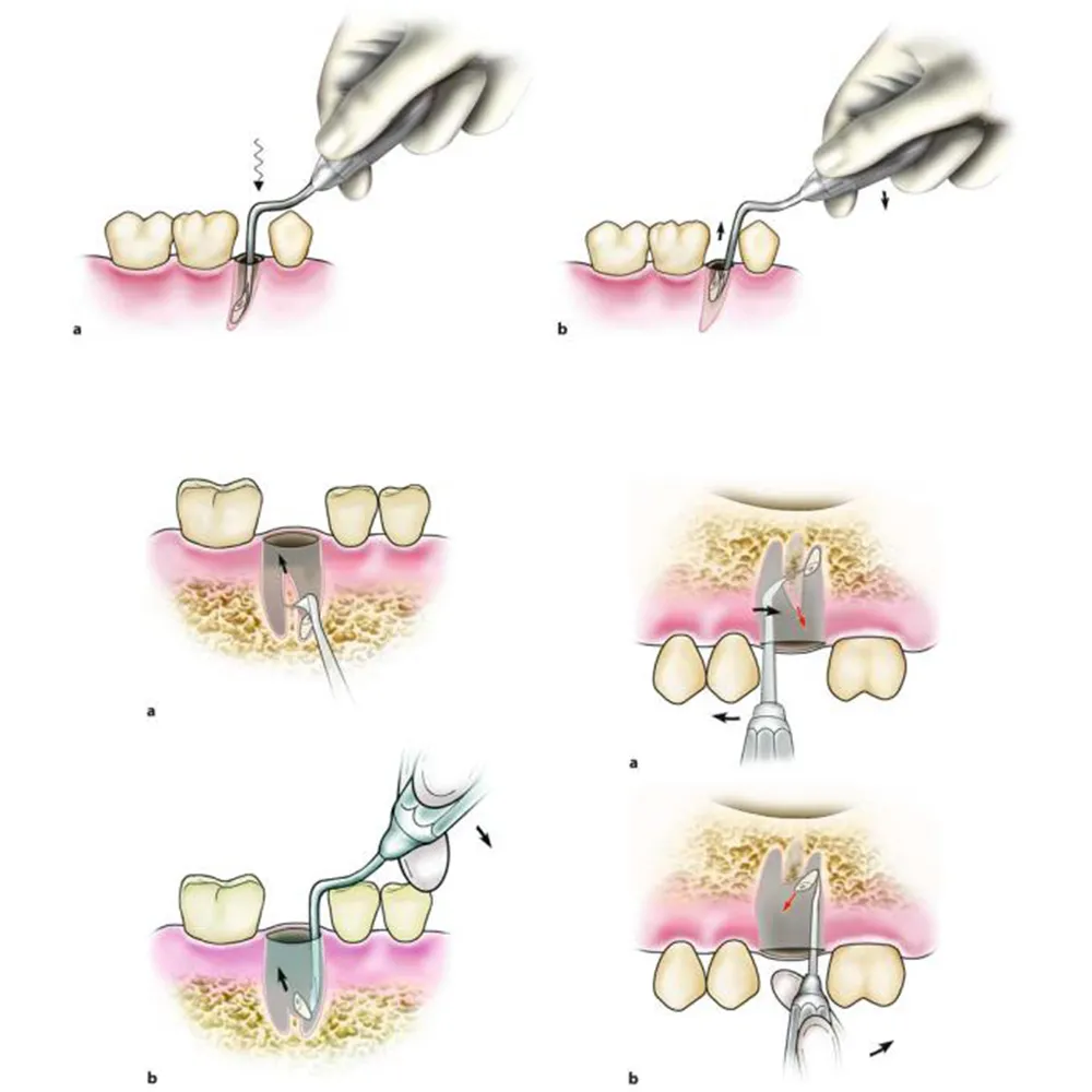 Oracraft Heidbrink Root Elevator And Root Tips