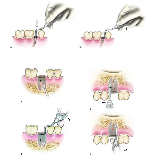 Oracraft Heidbrink Root Elevator And Root Tips