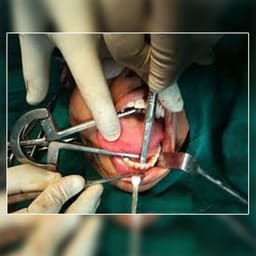 Waldent Heister Mouth Gag 8/112 - 8