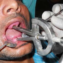 Waldent Heister Mouth Gag 8/112 - 7