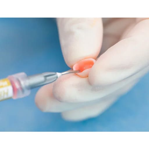 Vincismile HF-Etchant Hydrofluoric Acid Etching Gel