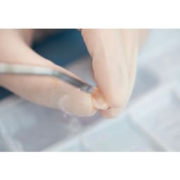 Vincismile HF-Etchant Hydrofluoric Acid Etching Gel - 3