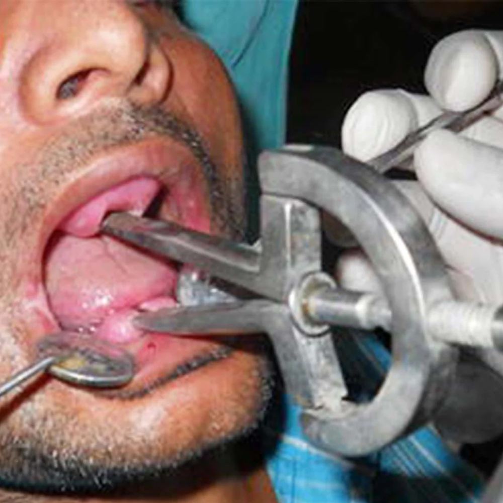 GDC Mouth Gag Retractors Heister (130cm) (Hmg)