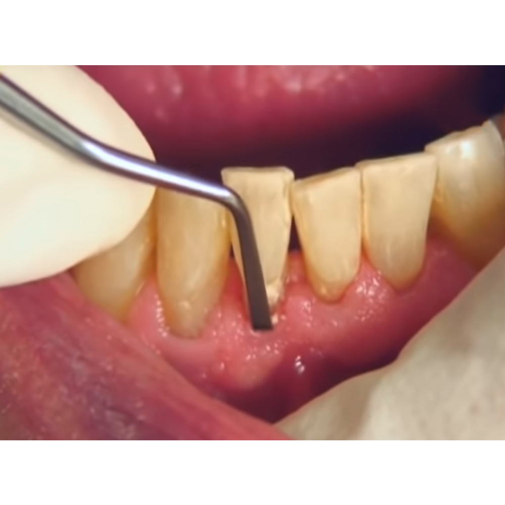 GDC Sickle Scalers Hoe Orban #6 (So6/7)