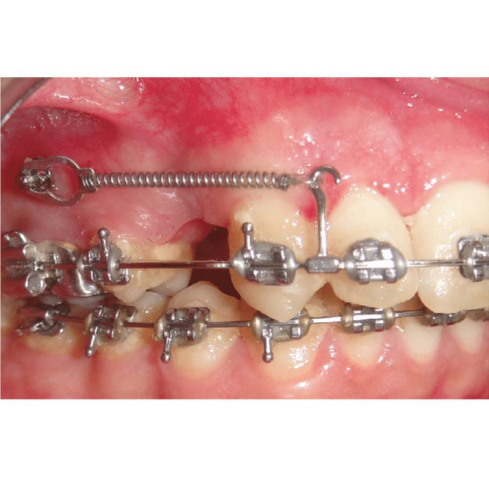 Ortho Direct Crimpable Hooks 