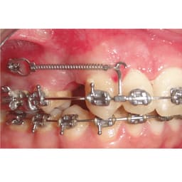 Ortho Direct Crimpable Hooks  - 6