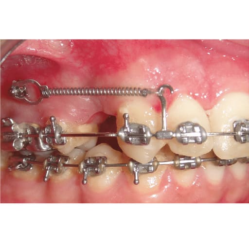 Ortho Direct Crimpable Hooks 