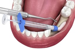 Advanced Biotech Osseograft DMBM Xenograft - 6