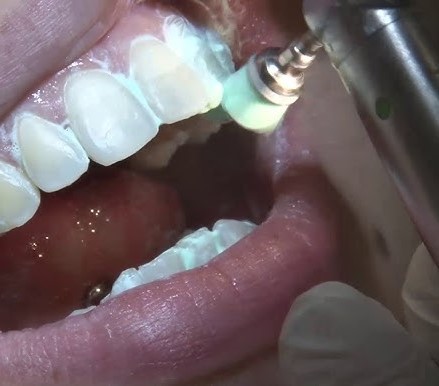 Rubydent RubyShine Prophylaxis Paste