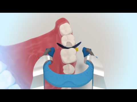 Polydentia MyQuickmat Classico Sectional Matrix Kit & Refills - 2