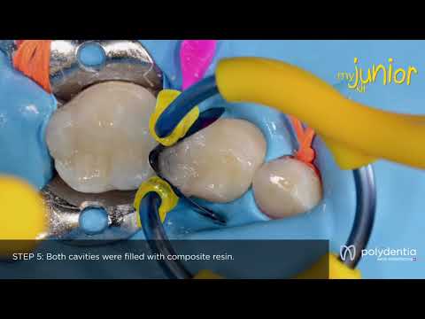 Polydentia myJunior Paediatric Sectional Matrix System Kit - 2