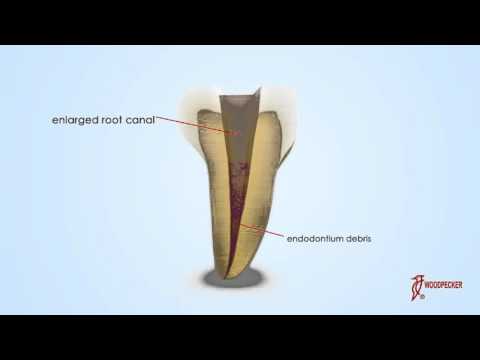 Woodpecker Scaler Tip E1 for UDS & EMS Scalers       - 2