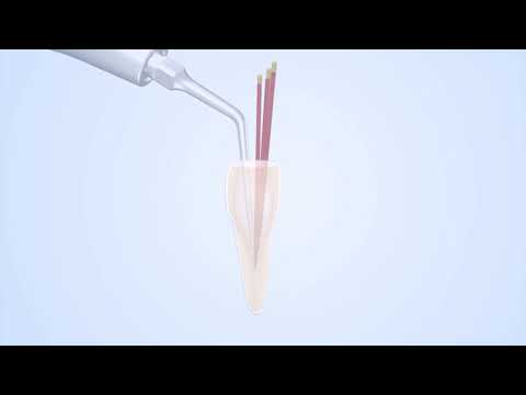 Woodpecker Scaler Tip E3D for UDS & EMS Scalers - 2